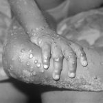 Mpox Explained
