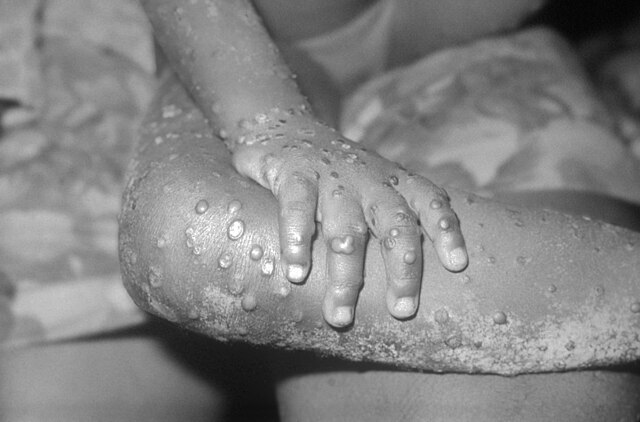 Mpox Explained